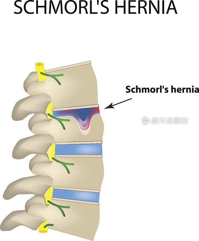 疝Schmorl。椎间盘。侧视图。脊柱。信息图矢量插图在孤立的背景
