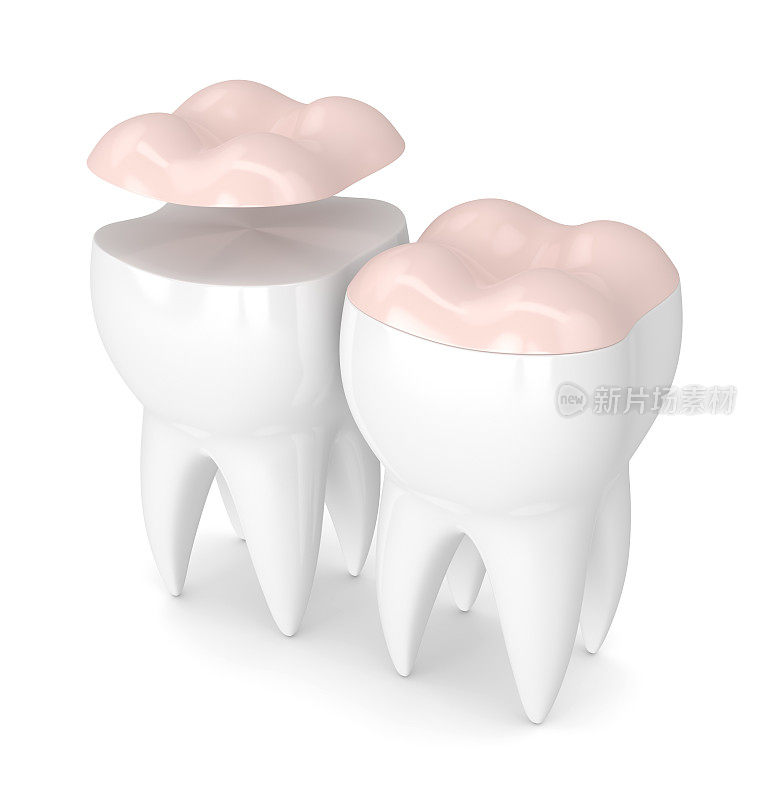 牙齿的3d渲染与牙齿高嵌