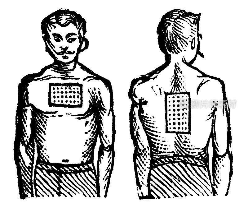 胸部和背部贴膏药的男子，19世纪