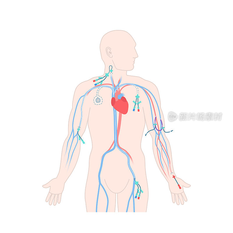 男性体内中心线静脉导管类型