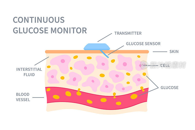 连续血糖监测传感器在皮肤插图