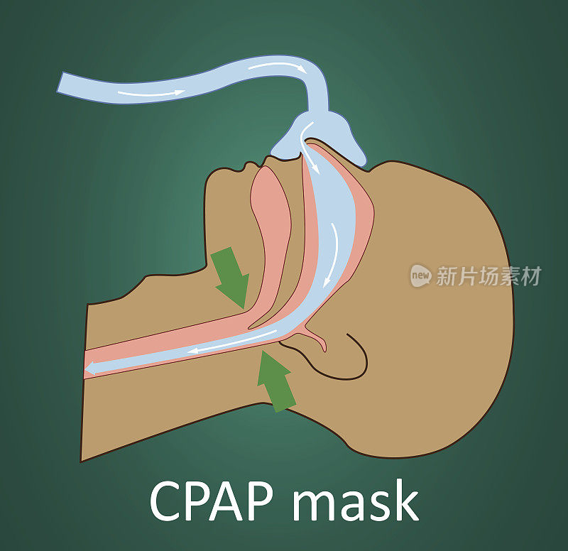 CPAP面罩呼吸矢量图。