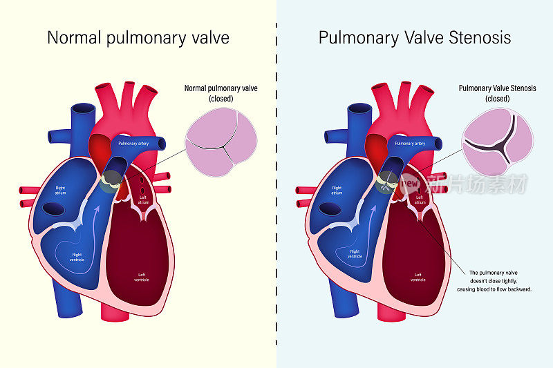 正常肺动脉瓣与肺动脉瓣狭窄向量的差异。先天性心脏病。