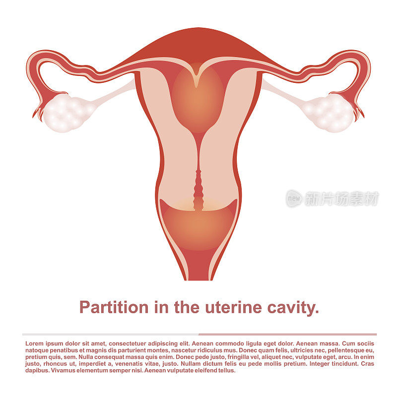 图示，女性生殖器官，在子宫内分割