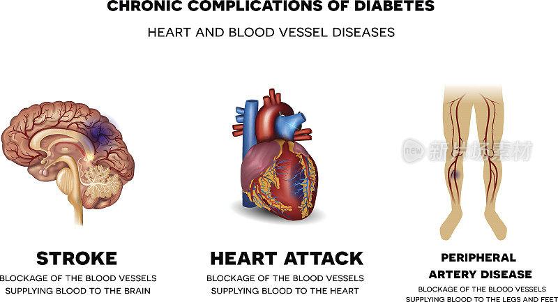 糖尿病的慢性并发症。心脏和血管疾病