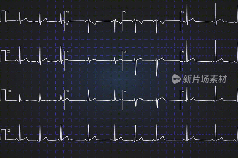 典型的人类心电图，白色的图上是黑色的