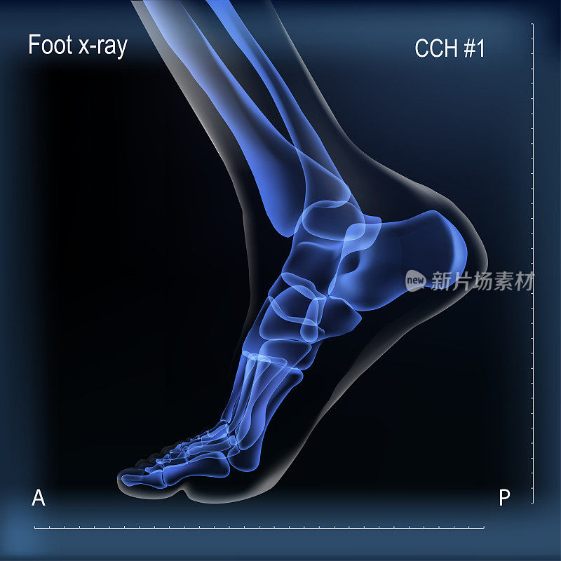 足部骨的x光片。
