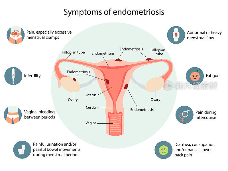 子宫内膜异位症症状信息图。详细矢量信息图。女性健康