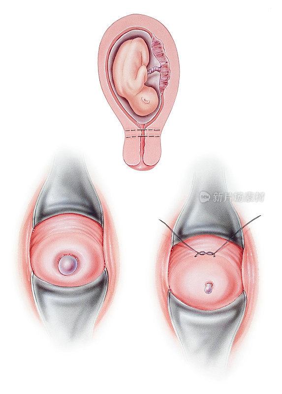 宫颈-宫颈环扎术