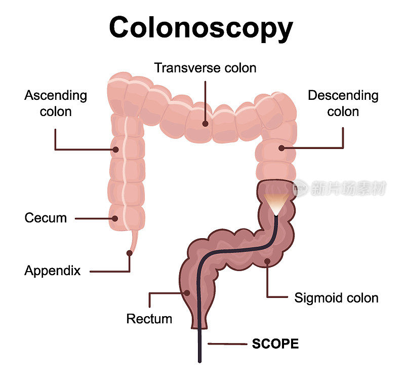 结肠镜技术概念与肠内呈现内窥镜
