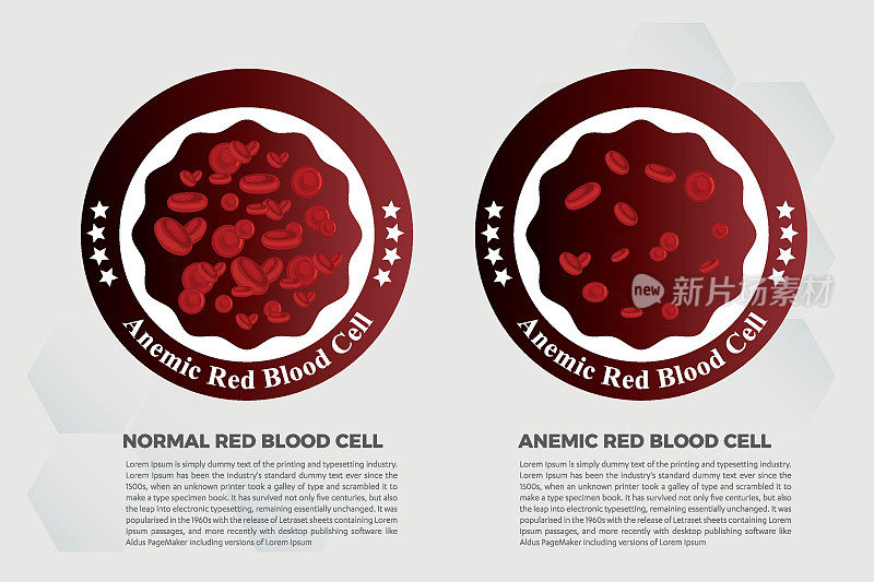 贫血铁血红细胞医学载体插图医学。