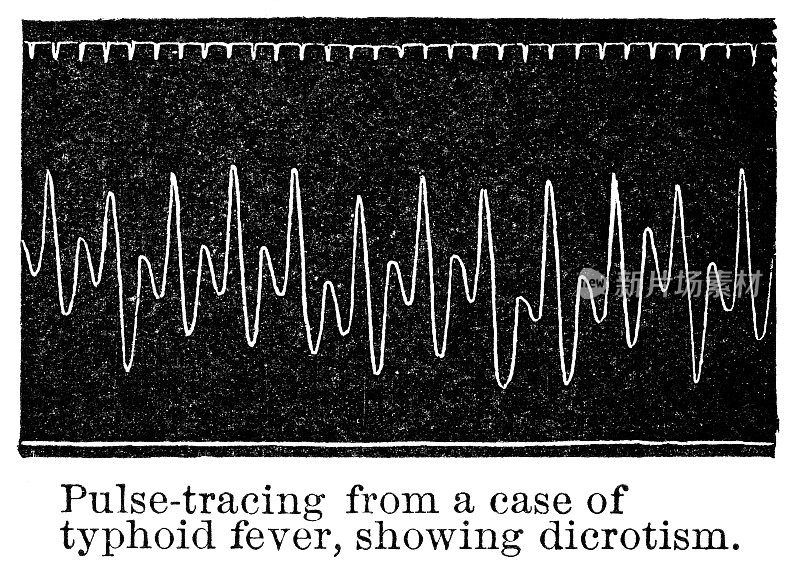 从19世纪一名伤寒病人的脉搏描记器中提取的二色脉迹