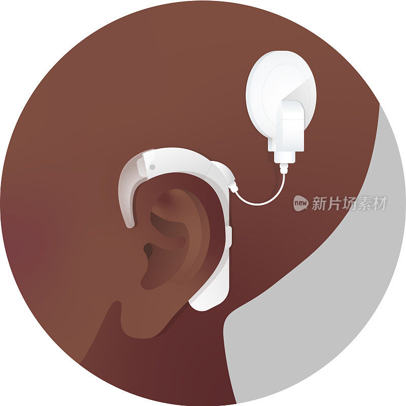皮肤黝黑，植入白色耳蜗以帮助听力丧失的人