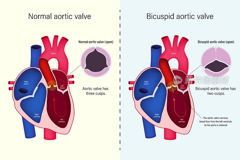 正常心脏瓣膜与二尖瓣主动脉瓣向量的差异。先天性心脏病。主动脉瓣狭窄(主动脉瓣狭窄)。