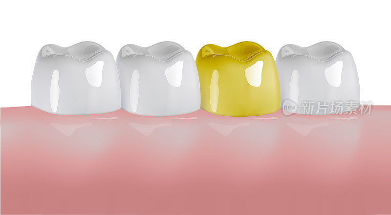 臼齿种植，桥接或贴面治疗缺牙手术修复。人工假体或口腔冠作排隙填充物。