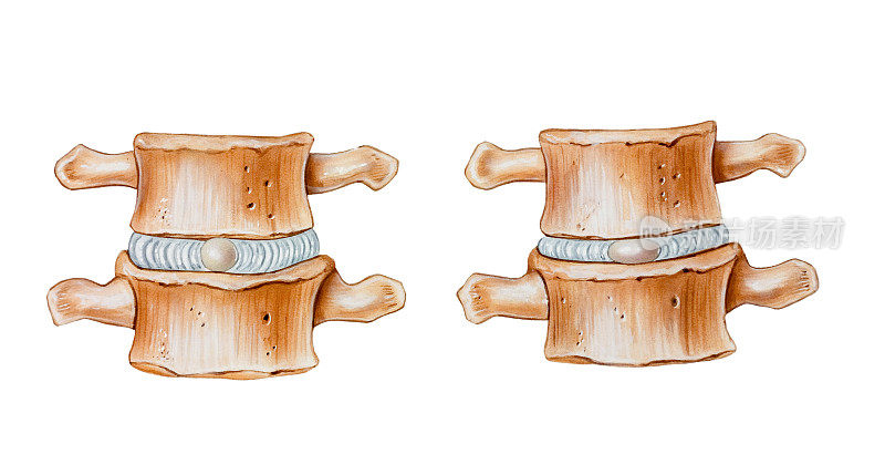 脊柱-椎间盘的缓冲功能