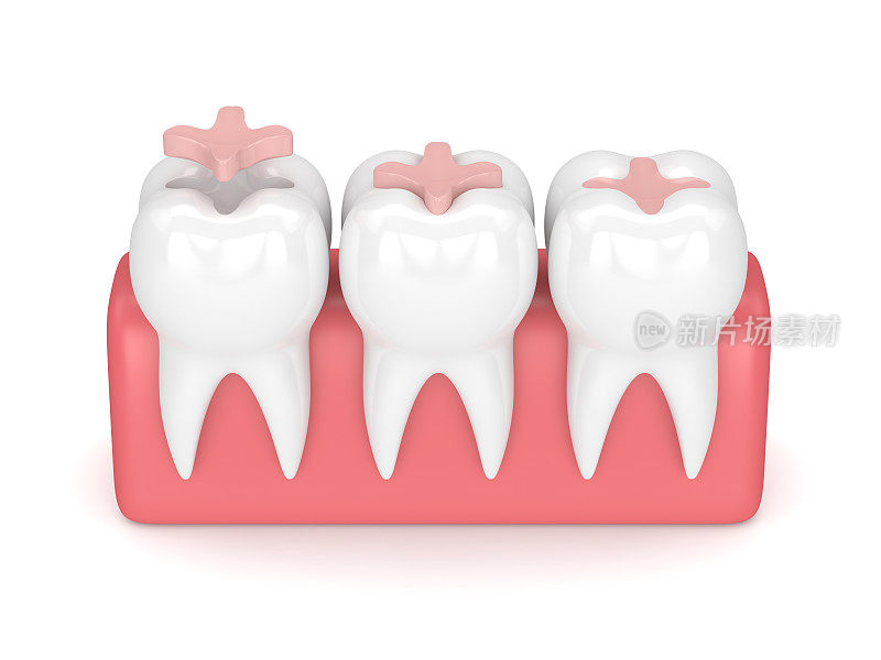牙齿的3d渲染与牙齿镶嵌填充