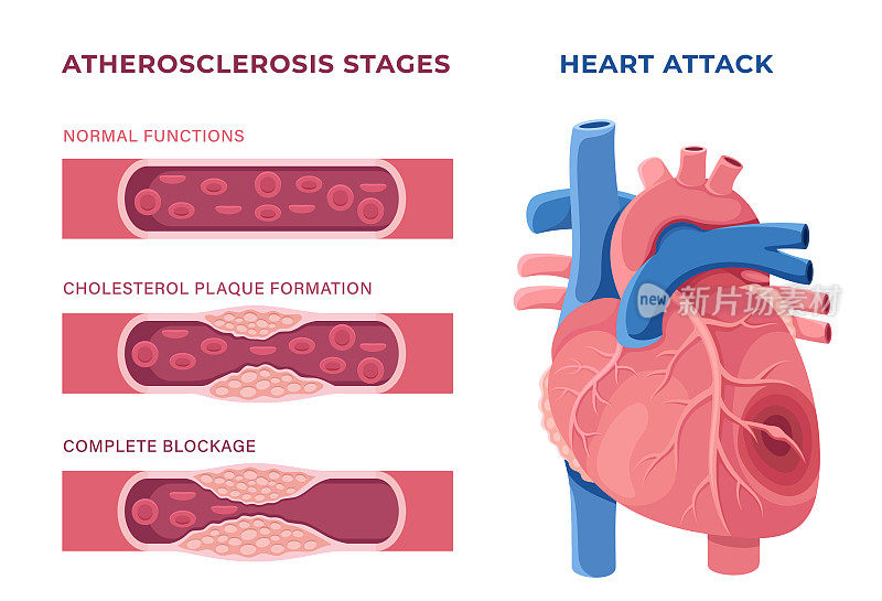 心脏病的概念。不健康的心脏。有动脉粥样硬化斑块的心脏。