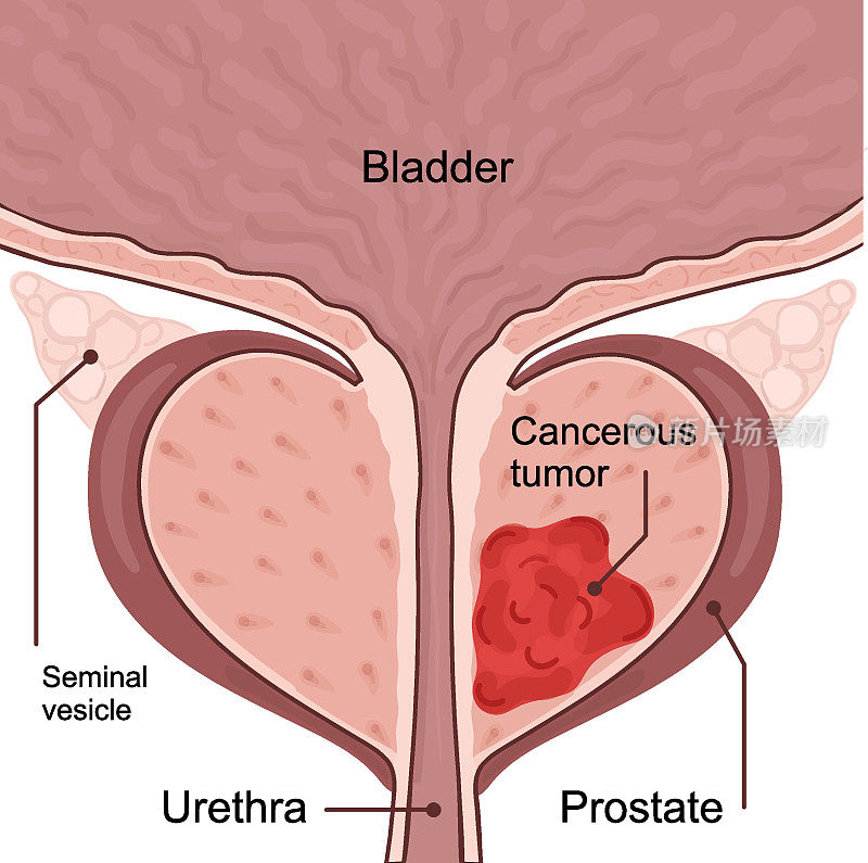 前列腺癌2期医学图示。