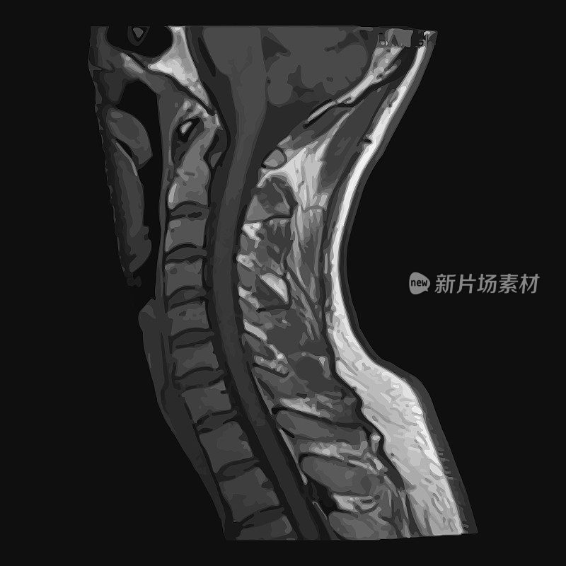 真实颈椎矢状面CT扫描、MRI脊柱颈层磁共振成像。孤立在黑暗的背景。矢量插图。