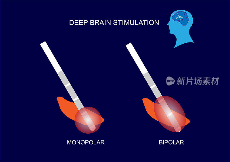 DBS治疗帕金森病的脑刺激模式