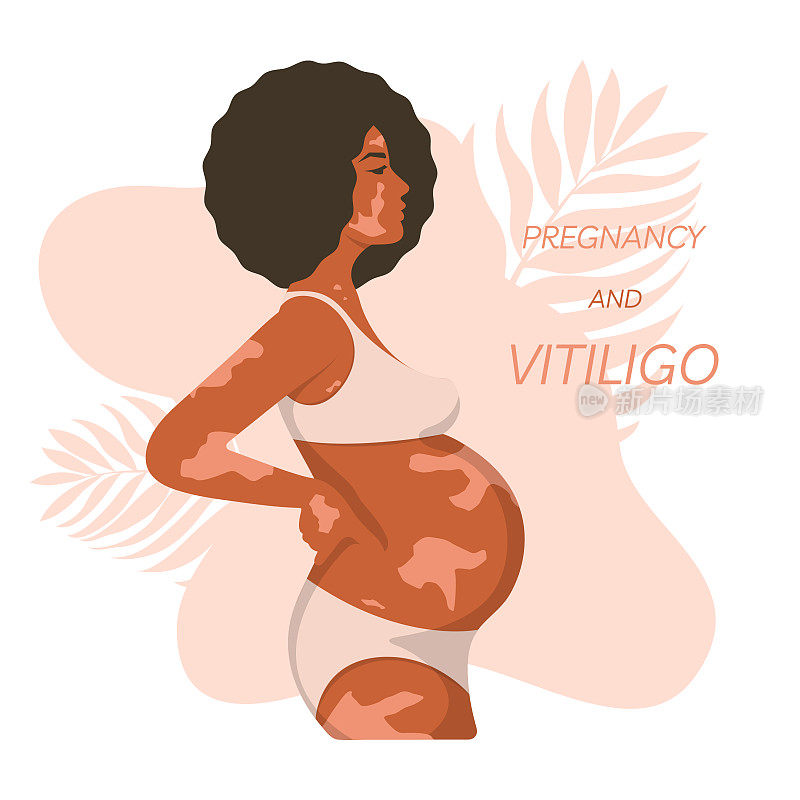 患有白癜风的黑人孕妇。一名皮肤上有色素沉着的非洲妇女，穿着内衣，站着用手支撑她的下背部。怀孕和白癜风。矢量插图。