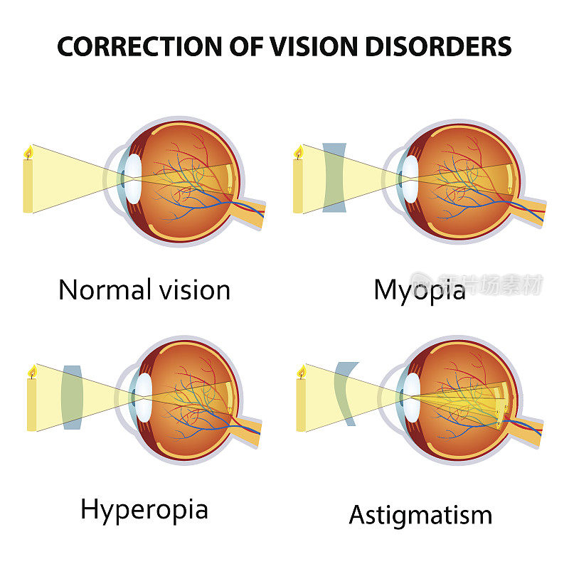 用晶状体矫正视力障碍。