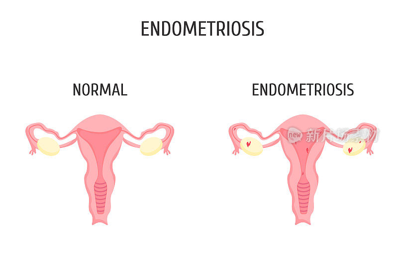 有无子宫内膜异位症的女性生殖器官。信息图。