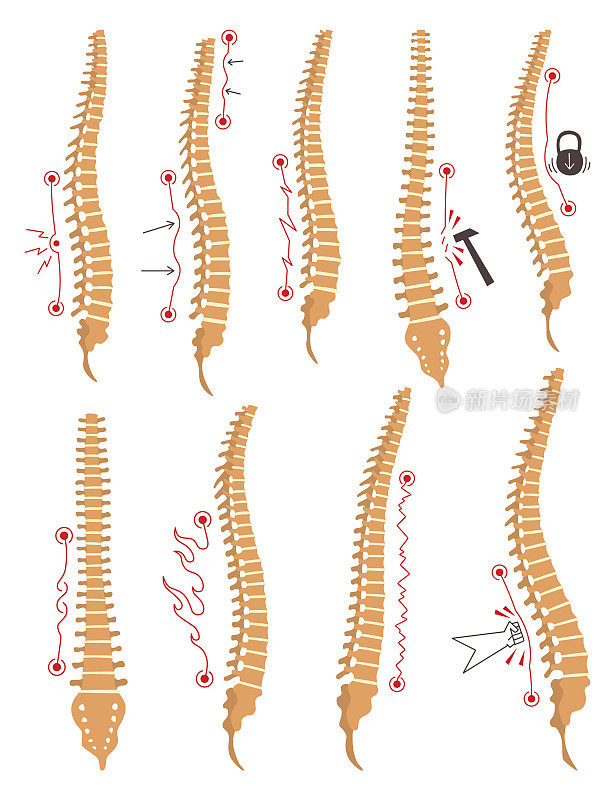 脊柱畸形类型。脊柱弯曲或不健康的脊骨的标志。人体脊柱解剖学，弯曲脊柱。带有标记部分的图表。身体姿势缺陷