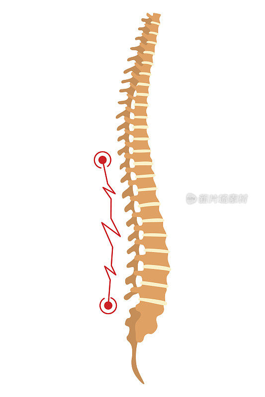脊柱畸形。象征脊椎弯曲或不健康的脊骨。人体脊柱解剖学，弯曲脊柱。带标记截面的图表。身体姿势缺陷