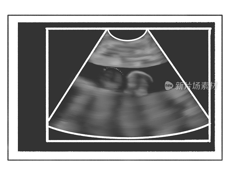 胎儿的超声波扫描;怀孕18周