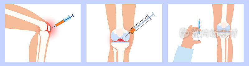 膝盖注射过程