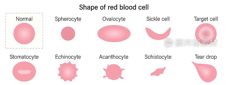 红细胞形态。红细胞的形状。球细胞、卵母细胞、镰刀细胞、靶细胞、口细胞、棘细胞、棘细胞、血吸虫细胞、泪滴。