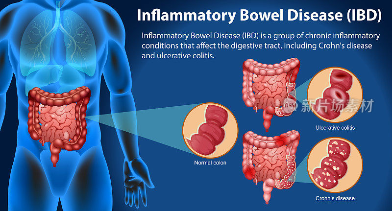 炎症性肠病(IBD)信息图