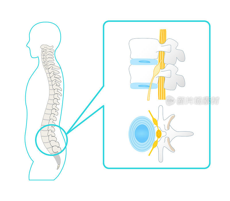 腰椎间盘突出症图示