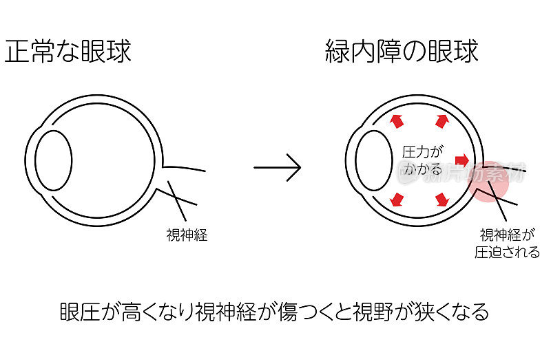 青光眼如何工作的插图，正常和青光眼，医学插图