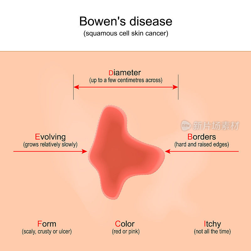 鲍文的疾病。鳞状细胞皮肤癌。