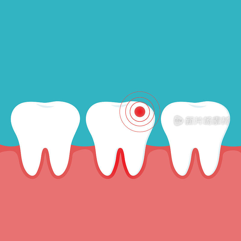 发炎的牙齿、牙龈和健康的牙齿的插图。牙龈炎。牙科诊所和口腔护理手册的概念。