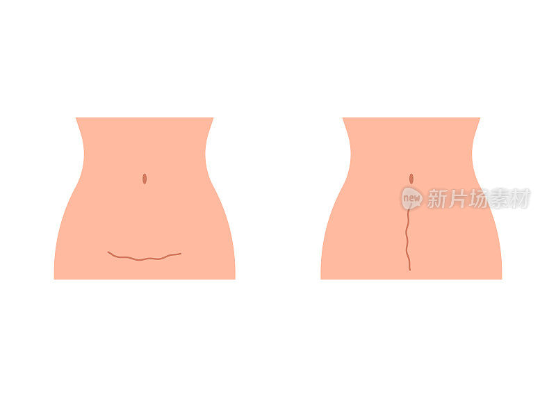 剖宫产后妇女腹部瘢痕。妇女腹部，结果剖腹产手术。母亲分娩。矢量图