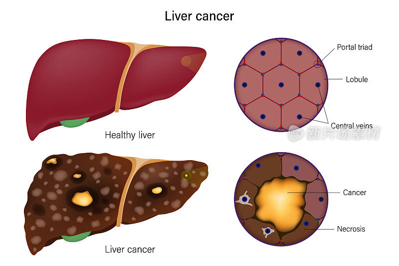 肝脏组织学。正常肝和肝癌。用于医学教育和科学的肝病。
