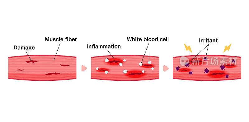 肌肉酸痛的机制矢量说明