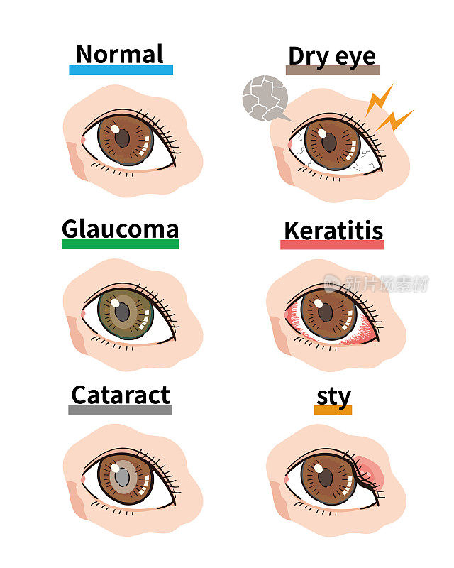 眼科疾病
