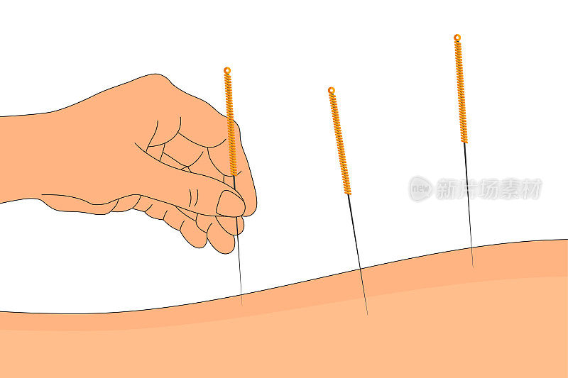 针灸旗帜模板。人的手与中国针在背上替代医学和治疗。医学媒介孤立插图