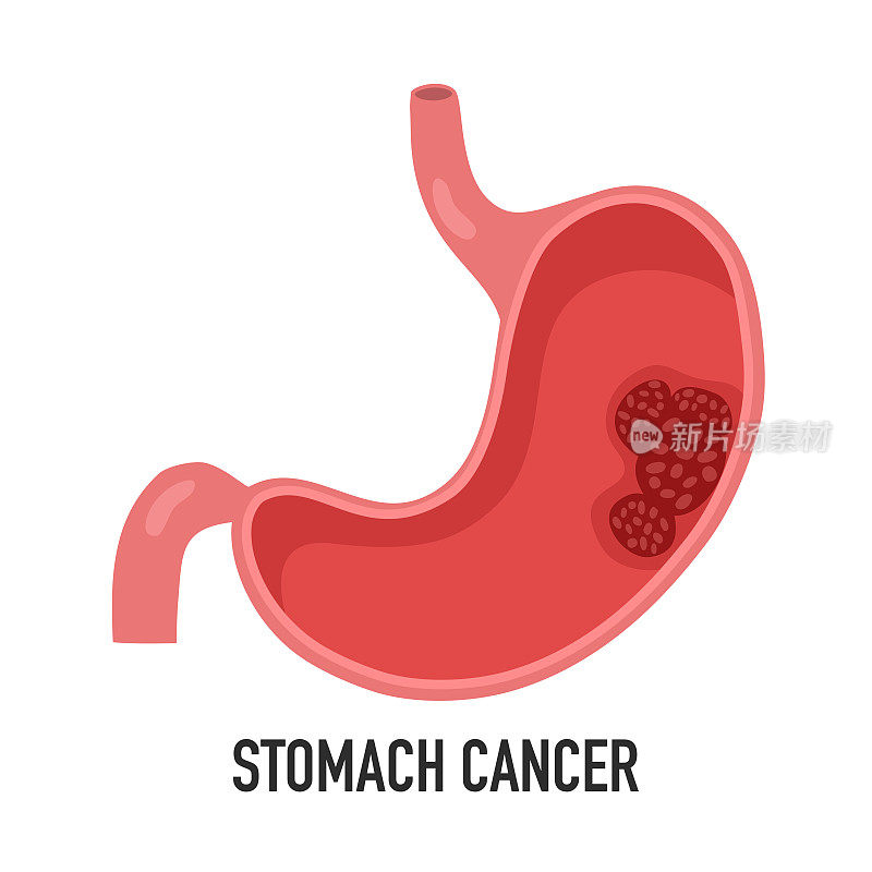 胃癌疾病概念矢量插图在白色背景。