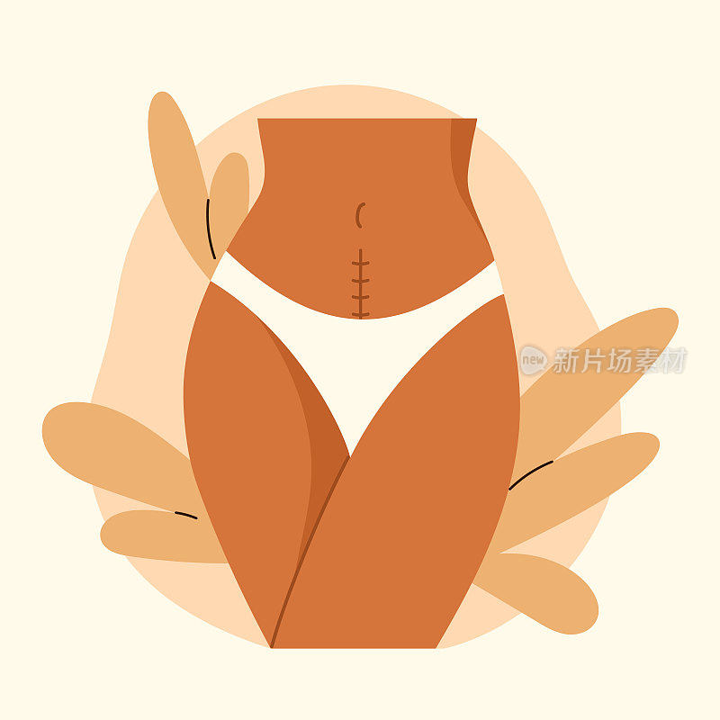 剖腹产疤痕。女性腹部剖宫产后缝线。剖腹产、手术分娩的操作概念。矢量插图在卡通风格。孤立的白色背景。