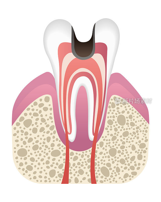 蛀牙的发展阶段。齿结构为平型。牙釉质导致蛀牙。牙病现实矢量插图