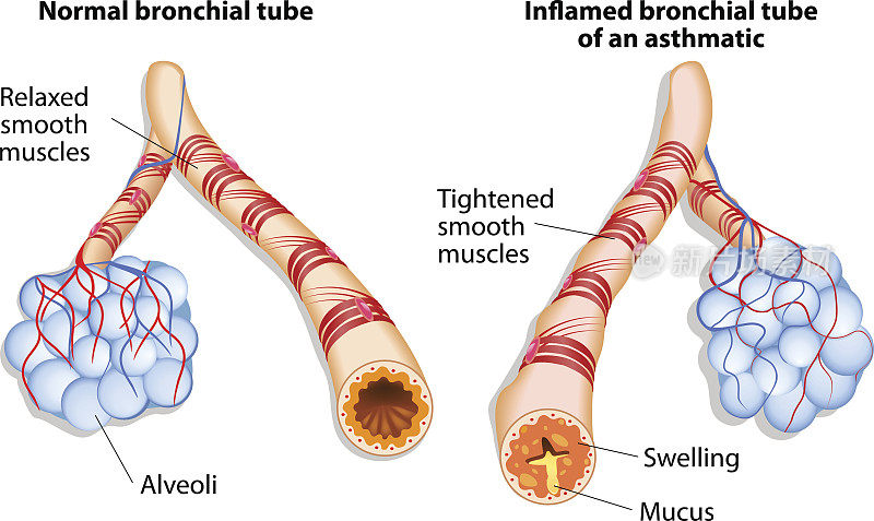 支气管发炎引起哮喘的支气管发炎
