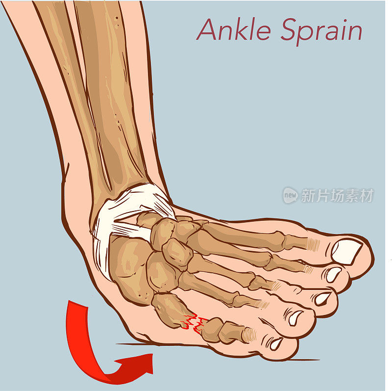 走路时脚踝扭伤。插图关于医疗和良好的足护理。