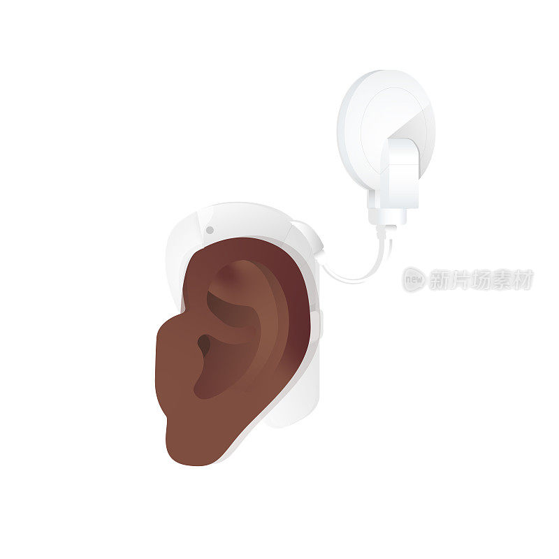 深色皮肤的耳朵，植入白色耳蜗以帮助听力丧失