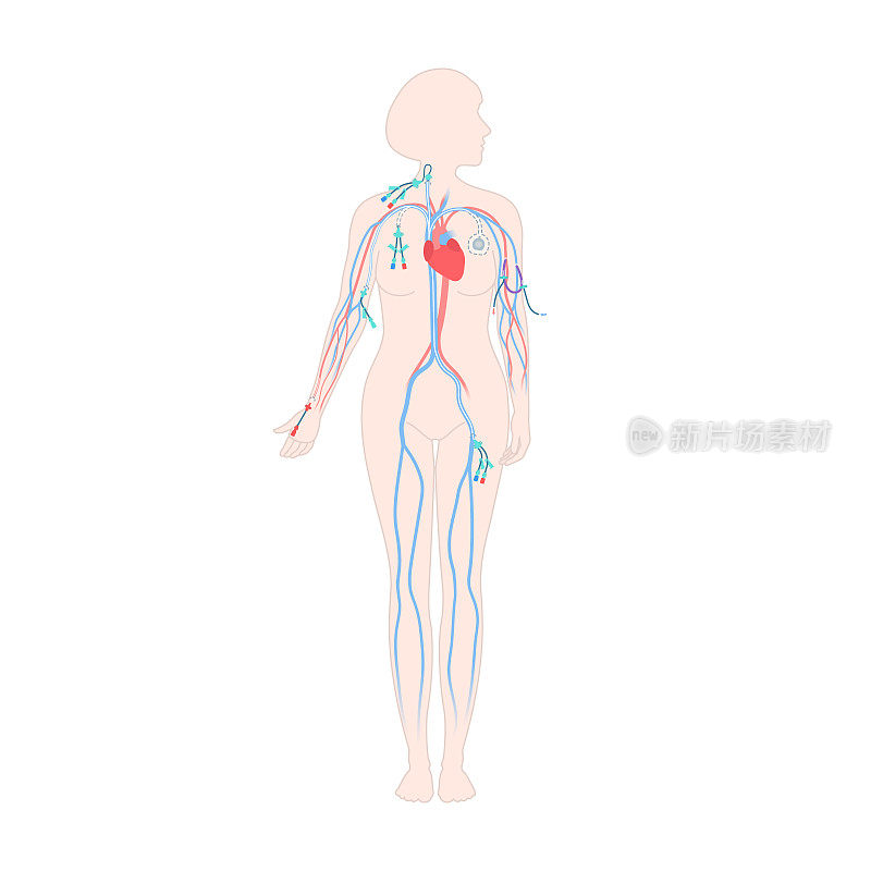 女性身体中心静脉导管类型